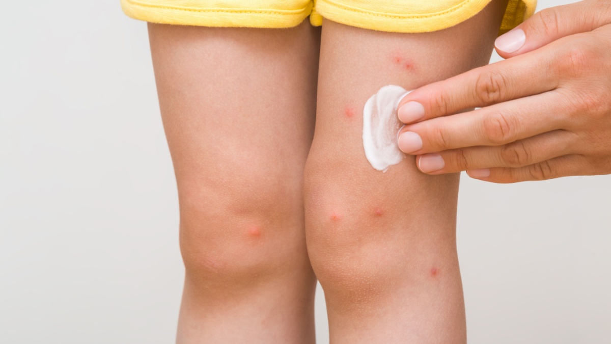 Gambe di bambino con punture di zanzare e crema
